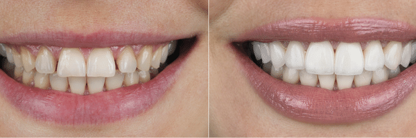 ציפויי שיניים מקומפוזיט לפני ואחרי